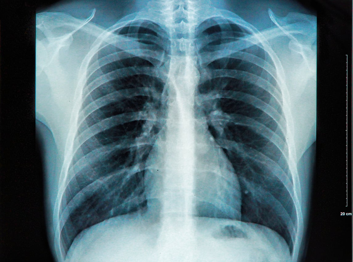 Chest X-ray Image